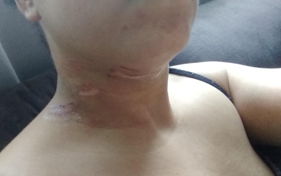 Motociclista tem o pescoço cortado por fio de energia solto em rua de Palmeiras de Goiás