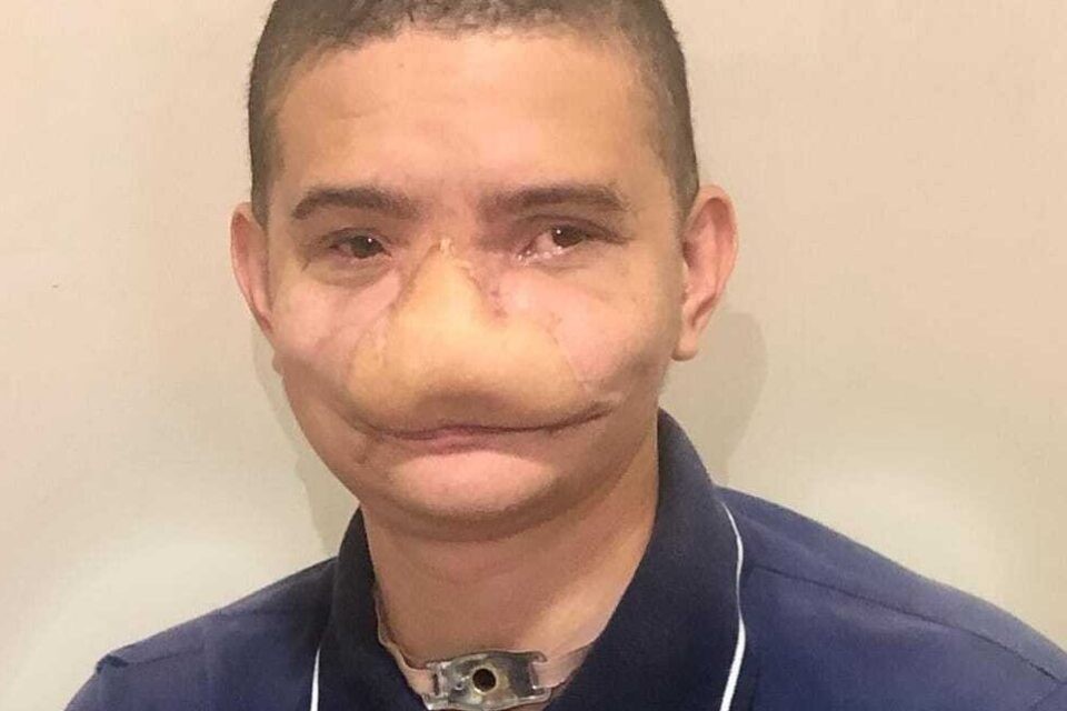 “Foi como um soco”, diz jovem que perdeu nariz ao ser atingido por fogos em Caldas Novas