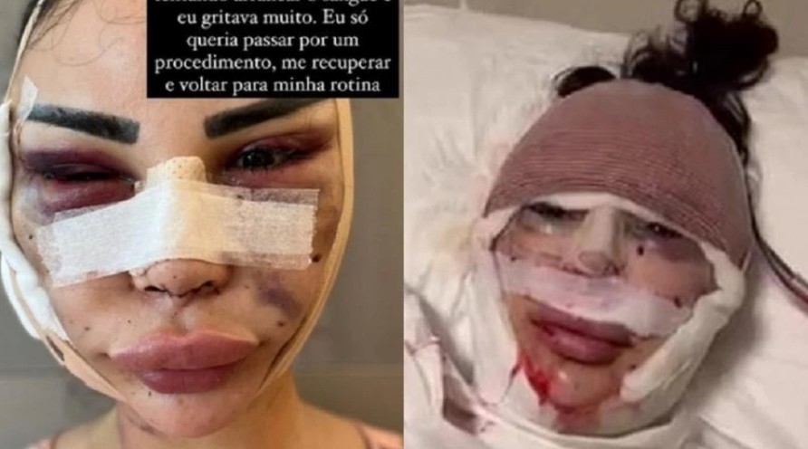 Modelo brasileira mostra rosto machucado e denuncia maus-tratos na Turquia