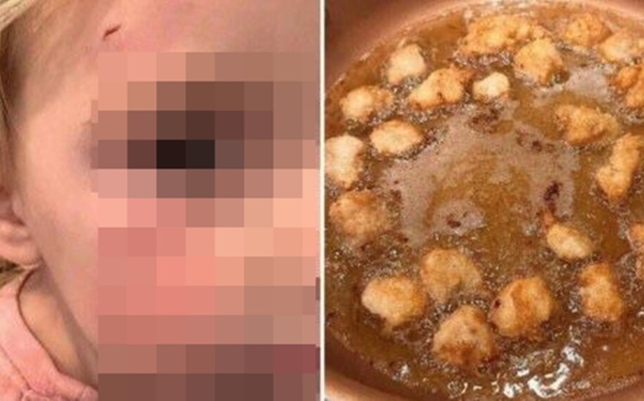 Mulher provoca ira na web por fazer nuggets do seu galo de estimação após ele bicar o rosto da filha